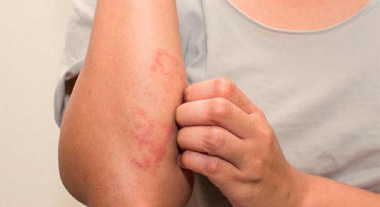 portada_psoriasis