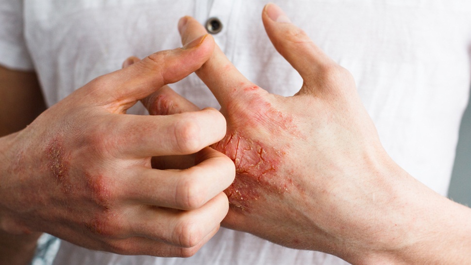 soriasis psoriasis