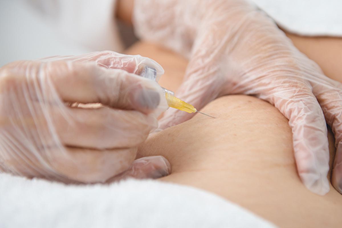 carboxiterapia