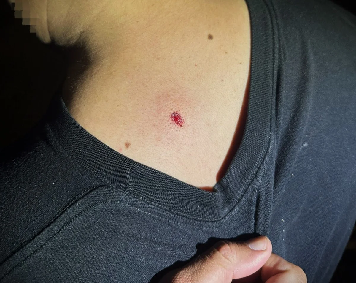 Joven herido por ataque con aire comprimido (Policía)